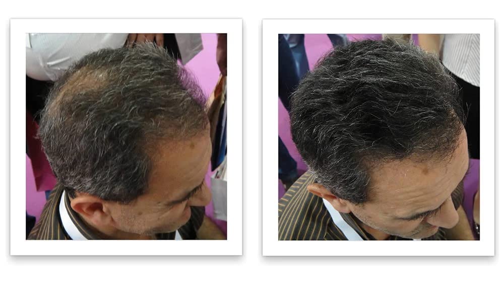 Trial Size - Eliminate Bald Spot and Thinning Hair Instantly. Make Thin Hair Look 10X Fuller. All-Natural Hair Thickening Fiber. Salt & Pepper - Dark