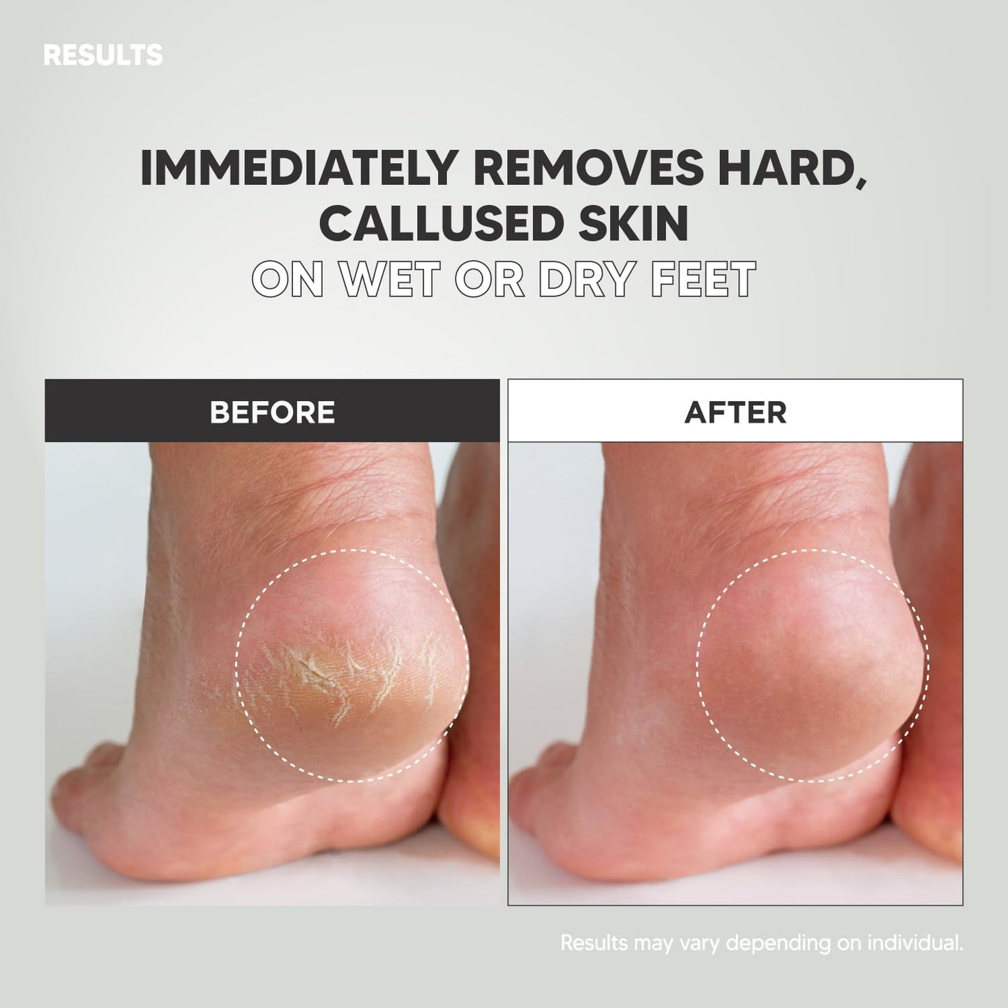 Wide Emery, Double-Sided Pedicure Tool, Colossal Foot File for Men & Women, Effective for Cracked Heel, Callus Remover, Foot Scrubber, Professional, (Gray)