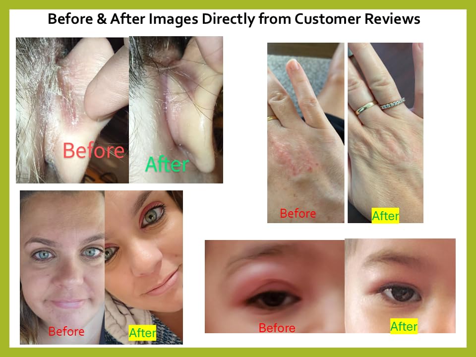 Tea Tree Oil Balm -100% All Natural | Great Cream for Soothing Irritations like Rashes, Insect Bites, Folliculitis, Acne, Itches, Dry Heels, Cuticles, Saddle Sores and more!