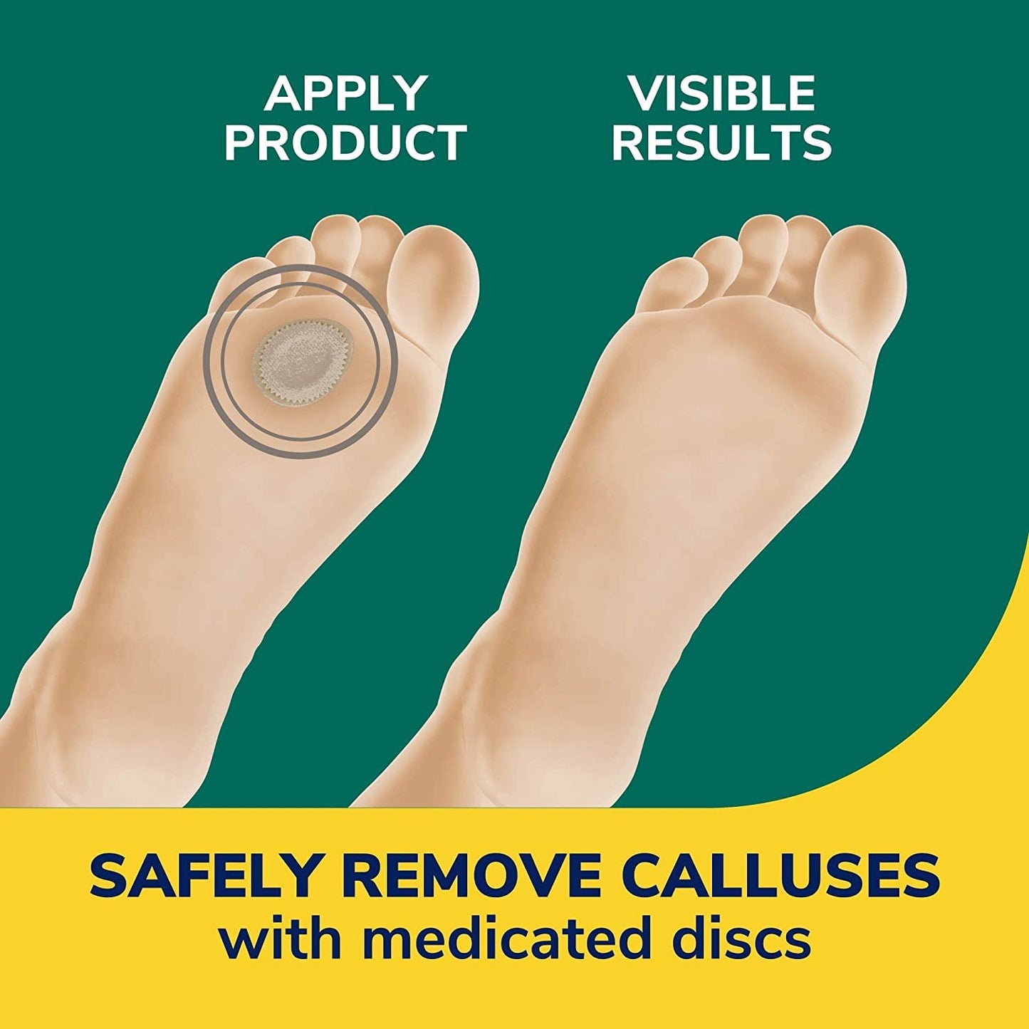 Dr. Scholl's Extra Thick Callus Remover, 4ct // Helps Soften Hard Calluses and Cushions for All-Day Pain Relief (Pack of 2)