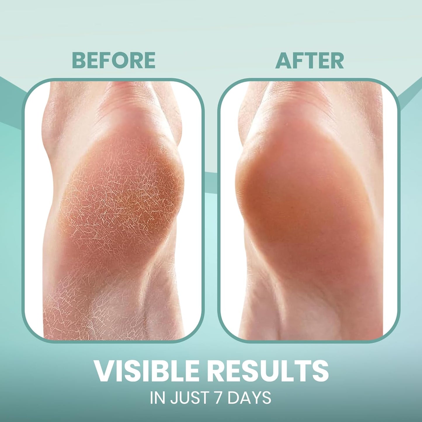 Moisturizing Heel Socks for Cracked Heels - Gel Socks for Dry Cracked Feet Repair - Silicone Socks for Women’s Foot Treatment & Overnight Hydration (Beige/Grey/Mint Green, 3-Pair)