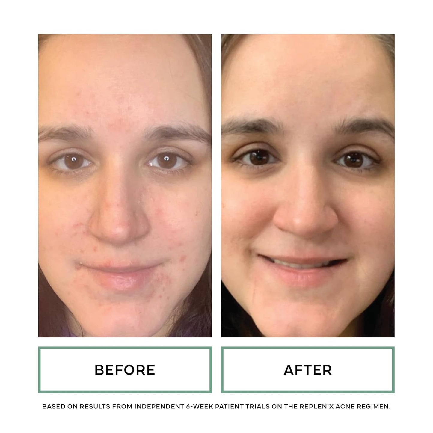 Replenix Gly-Sal Clarifying Acne Pads, 60 Count, Medical-Grade Glycolic Acid & 2% Salicylic Acid Exfoliating Pads for Acne-Prone Skin, Help Clear Blemishes & Refine Pores, Non-Oily