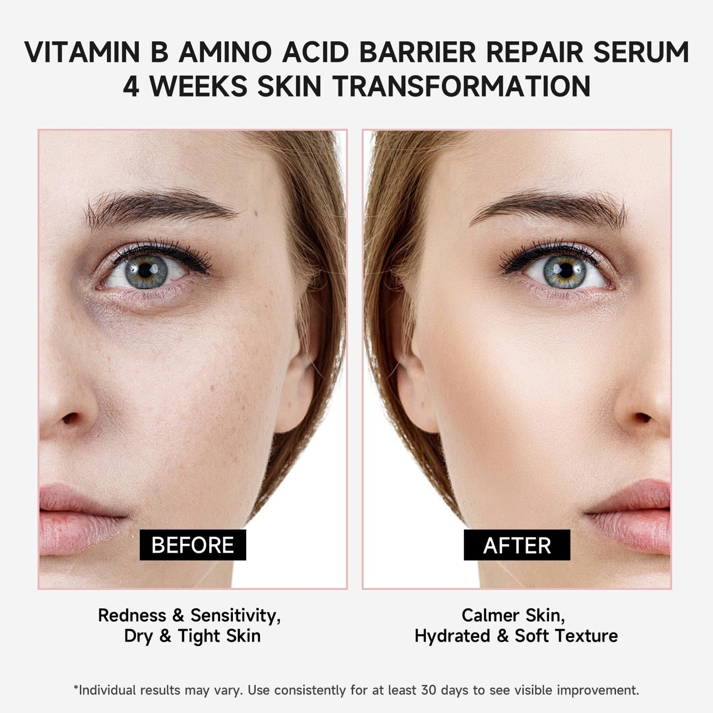 Vitamin B Amino Acid Barrier Support Face Serum - Preservative-Free Ampoule with B12, Hyaluronic Acid and Glutathione for All Skin, Especially Sensitive, Dry and Fragile Skin (1.5ml)30 Vials