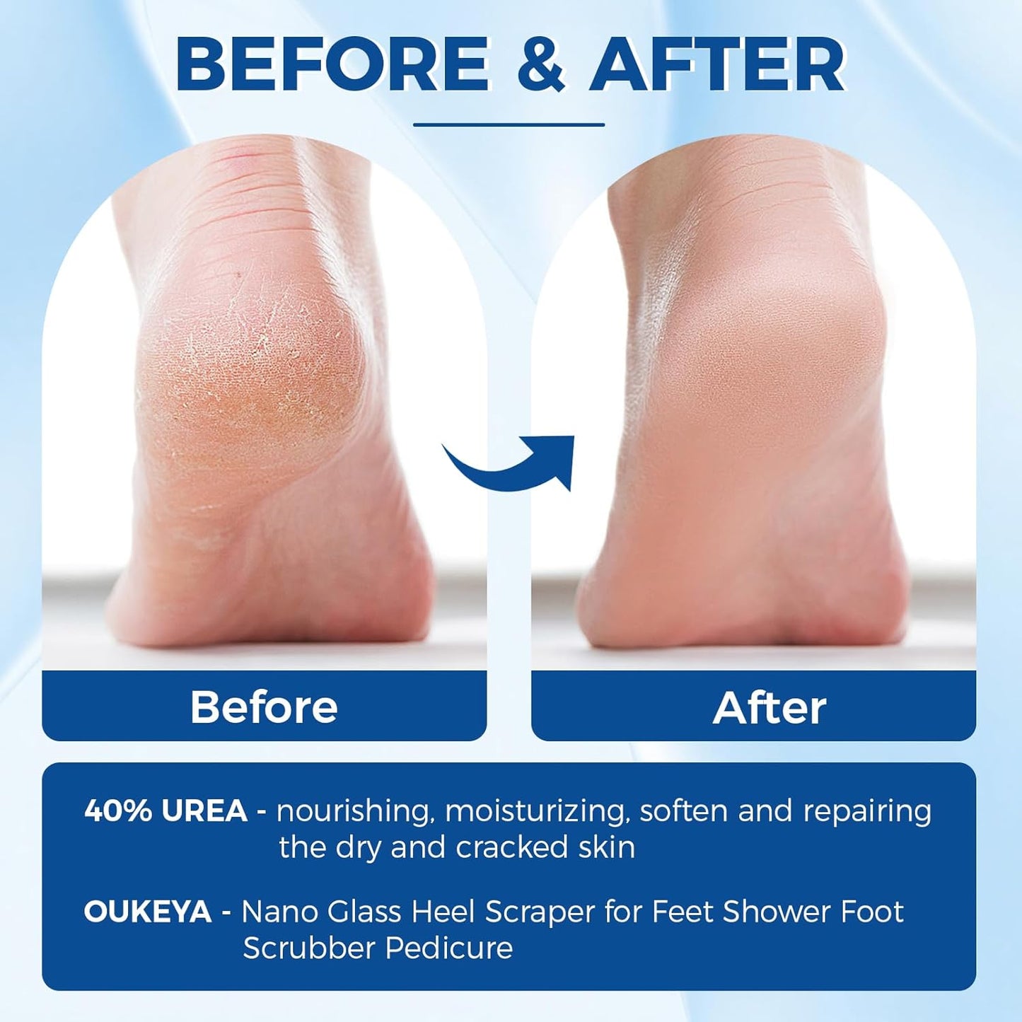 OUKEYA Urea Cream 40 Percent Tube, Urea Cream 40 Percent For Feet Maximum Strength, with Foot Callus Remover, Nano Glass Foot File