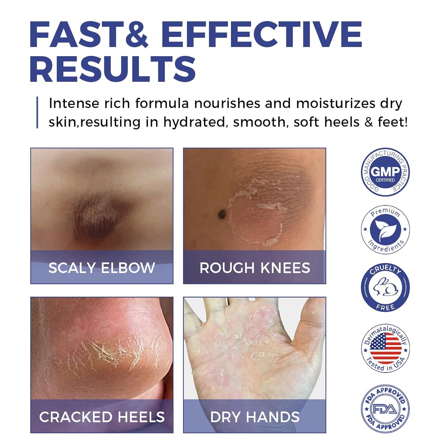 OUKEYA Urea Cream 42% plus Salicylic Acid 2% Intensive Repair Treatment for Cracked Skin on Hands, Heels, Elbows, and Lips - Relief for Dry Feet - Enhanced Pump Dispenser Packaging - Gross wt 8.03 OZ