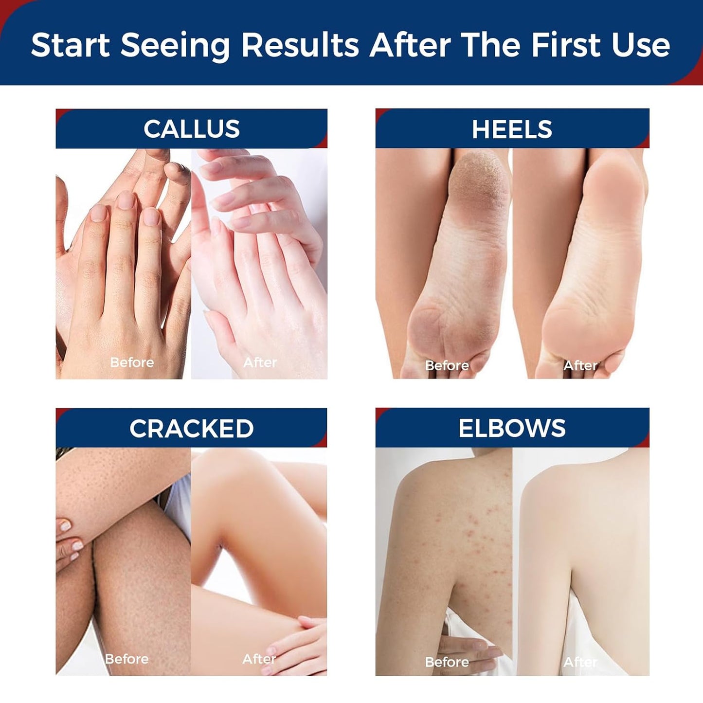 OUKEYA 2 Pack Urea Cream 42 Percent with 2% Salicylic Acid Tube 3 Oz