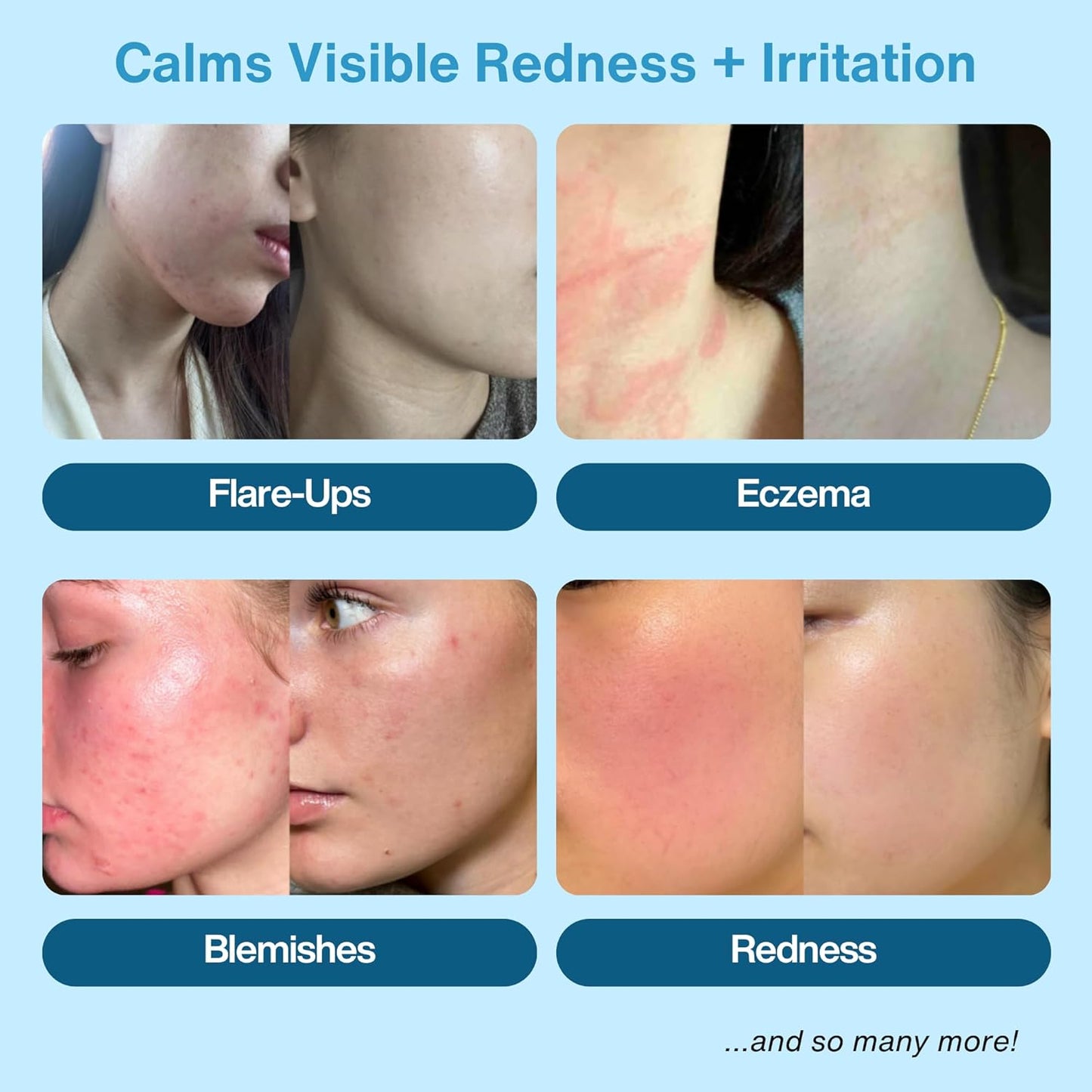 Honeydew Labs Hypochlorous Acid Spray – HOCl Face & Body Mist for Acne, Eczema & Irritation – Multi-Purpose Skin Repair – Eyelid Cleanser, Post-Workout/Procedure, Scalp & Sensitive Skin (2 oz+6.8 oz)