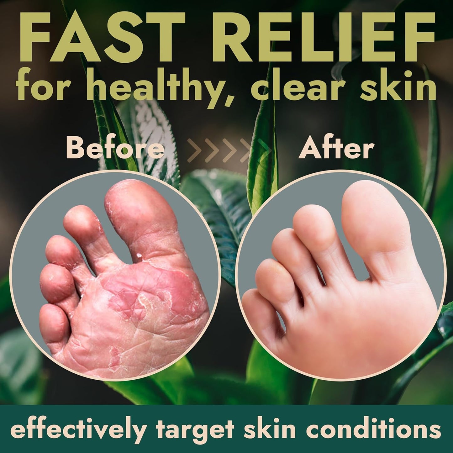 Terramed Just Think Comfort Foot Spray with Tea Tree Oil | Antifungal Treatment for Jock Itch, Nail Fungus & Ringworm | Fast Absorbing & Deep Penetrating Relief | Soothes Itching & Burning | 120ml