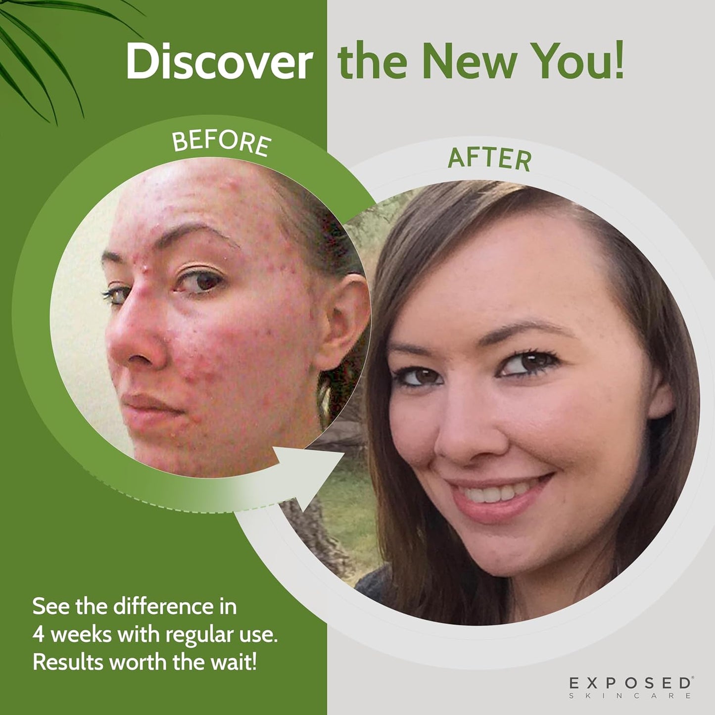 Exposed Skin Care, Acne Treatment Kit with 2.5% Salicylic Acid and 3.5% Benzoyl Peroxide to Clear Up Teen, Adult, Hormonal and Cystic Acne – Natural, Non-toxic and Cruelty Free