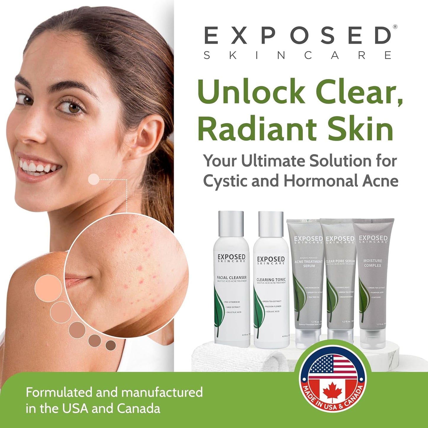 Exposed Skin Care, Expanded Acne Treatment Kit with 2.5% Salicylic Acid and 3.5% Benzoyl Peroxide to Clear Up Teen, Adult, Hormonal and Cystic Acne – Natural, Non-toxic and Cruelty Free