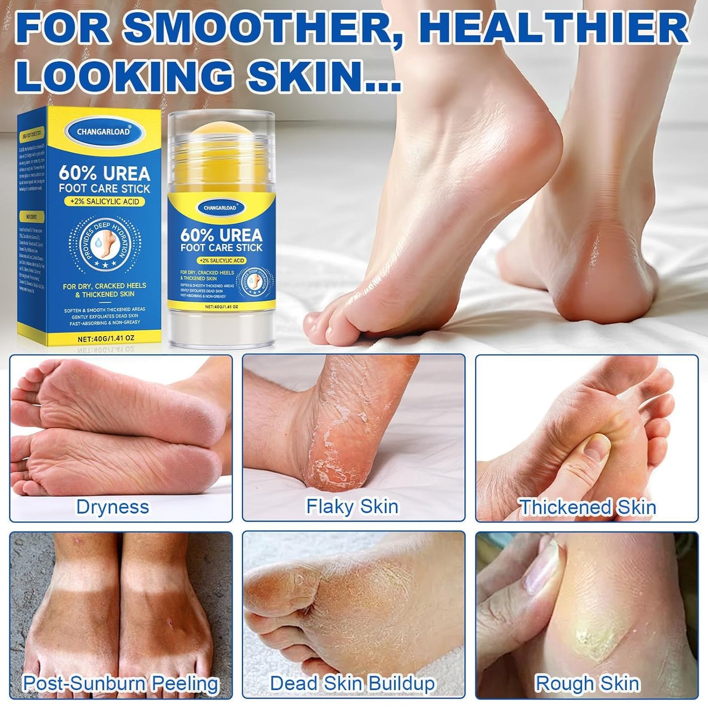 60% Urea + 2% Salicylic Acid Foot Cream–Ultra-Moisturizing Formula, Exfoliates Dead Skin, Softens Dry, Cracked Skin on Feet, Knees, Hands, Elbows. Helps soften callused, rough, or tender areas 1.41oz
