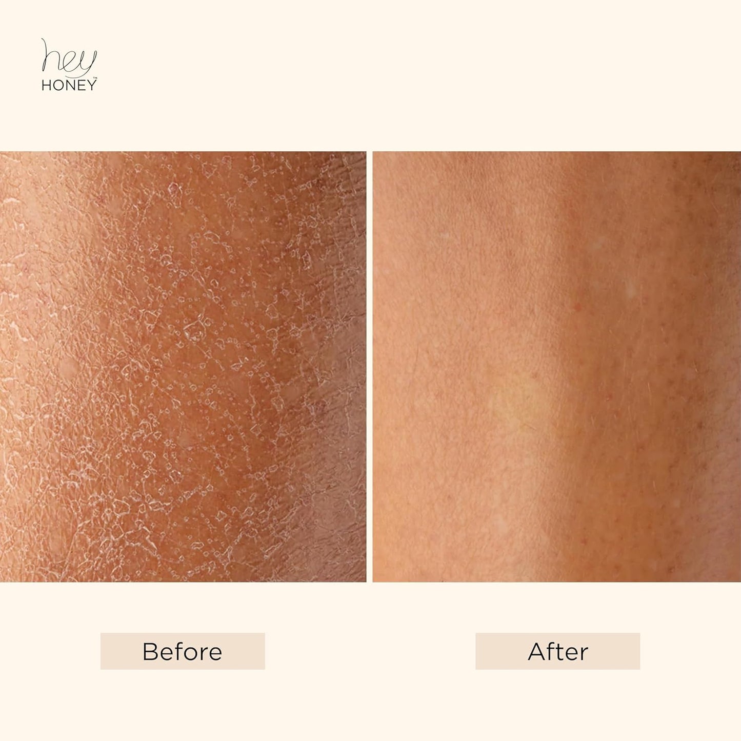 Hey Honey Skin Care Mango & Honey Water-Free Body Lotion - Hyaluronic Acid, Ceramides & Barrier Repair for Hands, Elbows & Dry Sensitive Skin | 24-Hr Hydration, Fruit Enzymes, Cruelty-Free | 6.7 oz