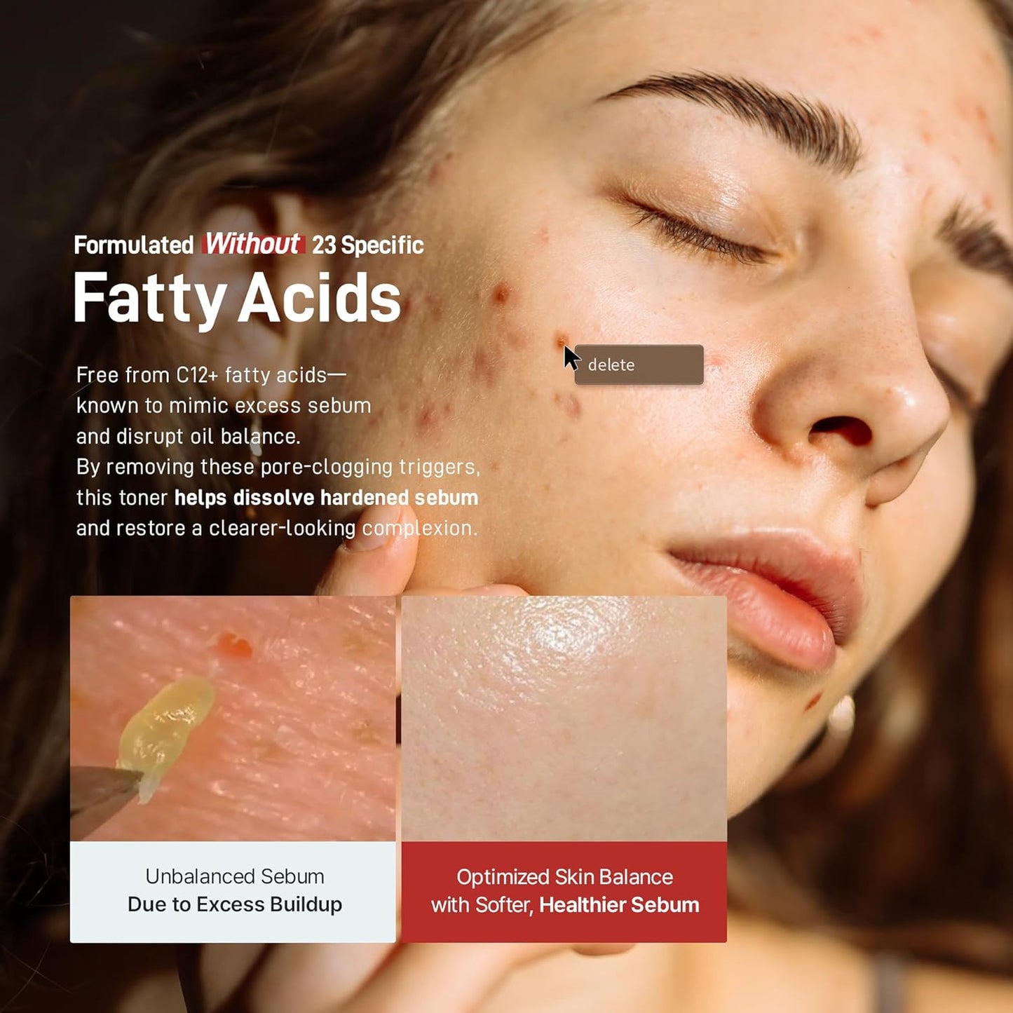 Zeroca 86 Korean Toner for Acne-Prone & Oily Skin – Fast Calming & Soothing for Breakout Relief – Calms Redness & Supports Clear Skin (6.76 fl.oz. 200ml)